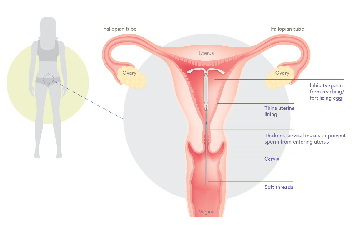 kyleena-in-the-body How Kyleena® works in the uterus