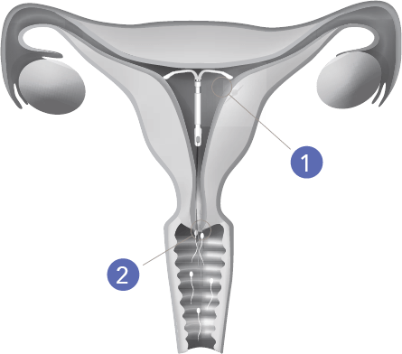 Title uterus - Image of uterus with a circled ‘1’ pointing to the cervix and a circled ‘2’ pointing at the uterine lining